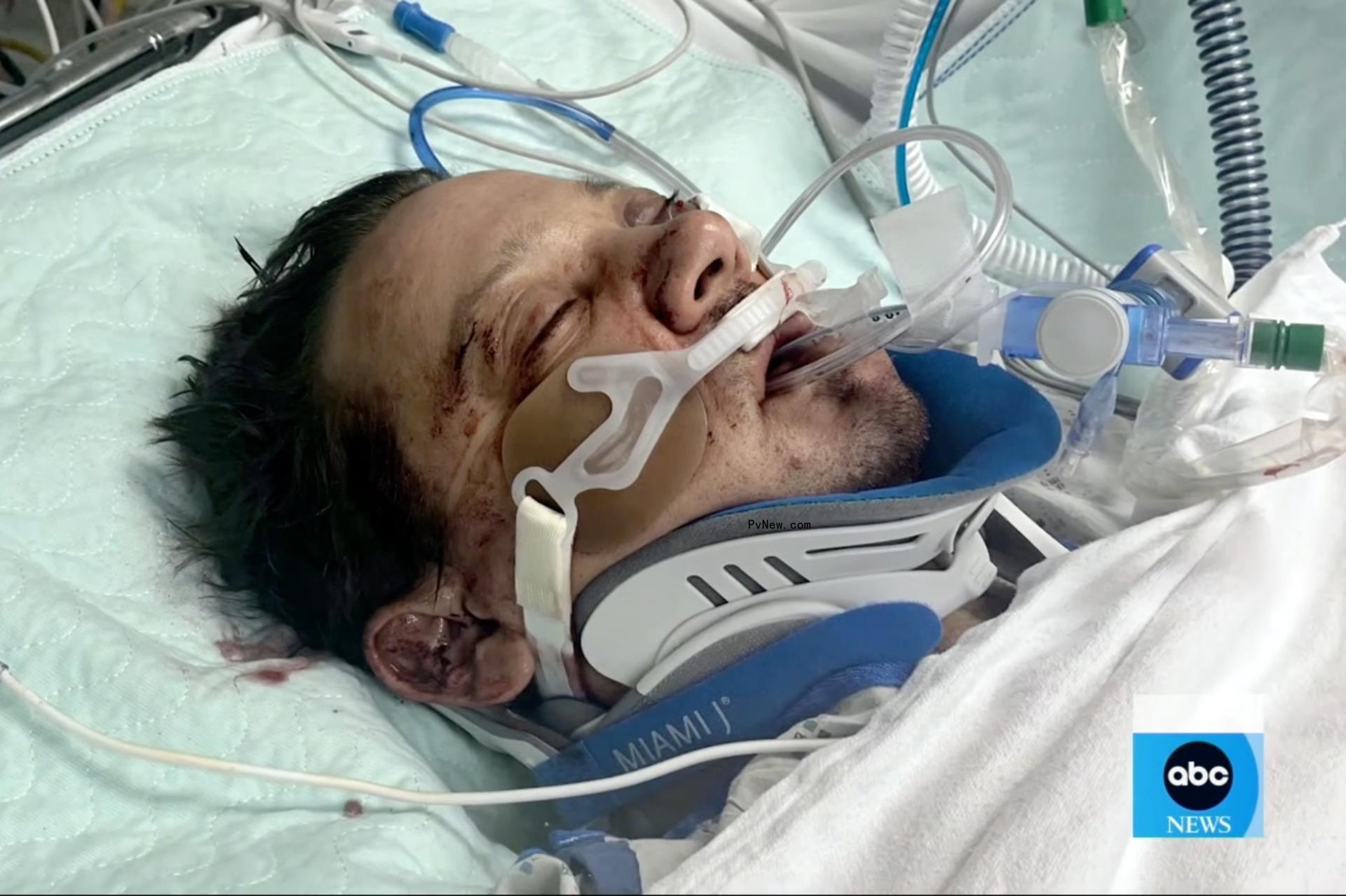 jeremy renner in a hospital bed intubated wearing a neck brace