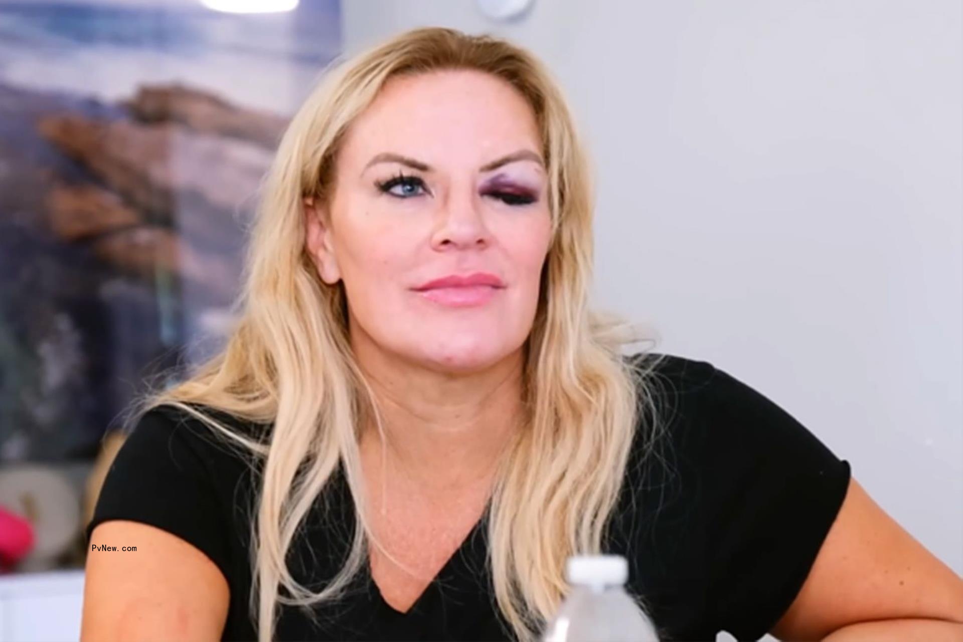 Heather Gay with a black eye