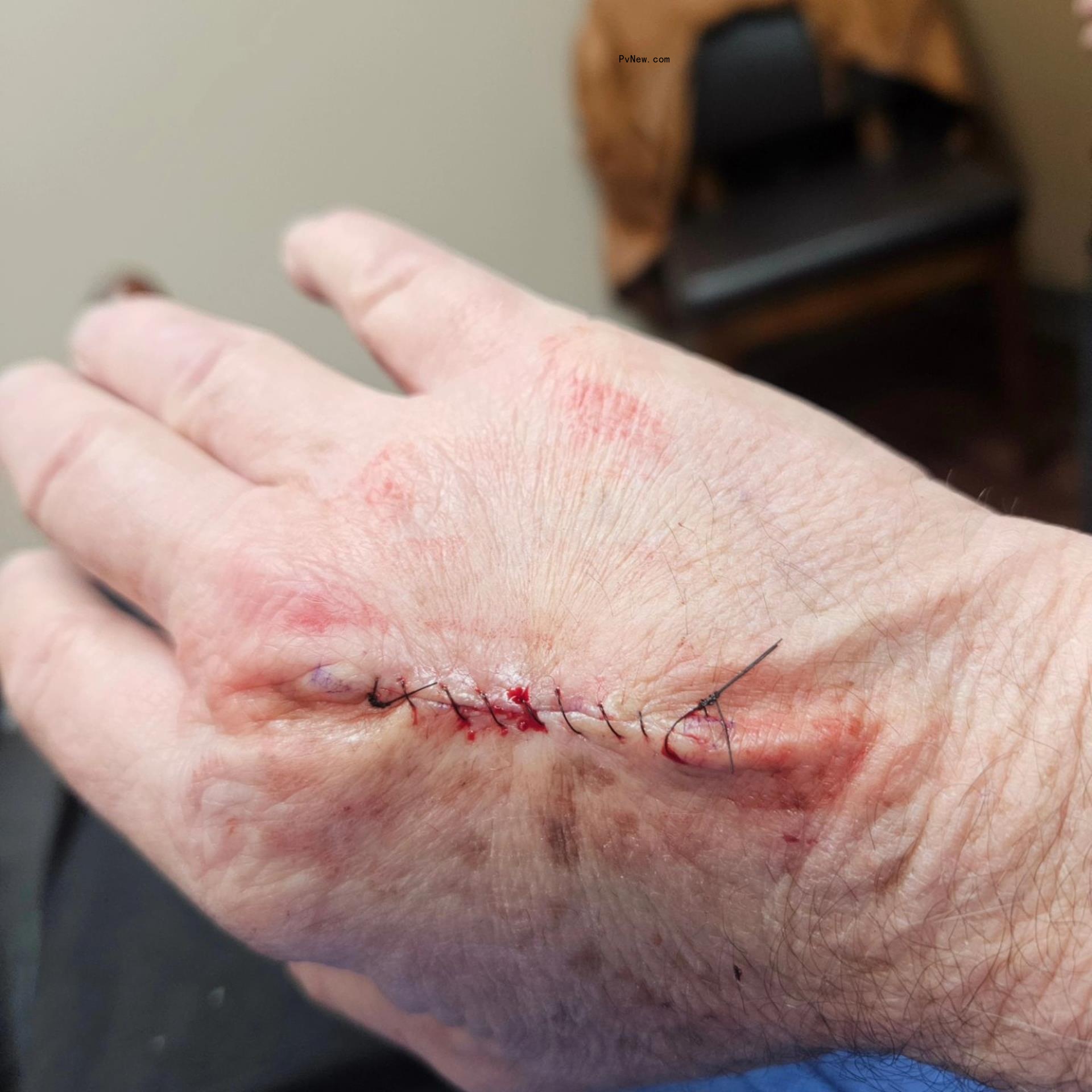 Michael Lohan's hand post-surgery