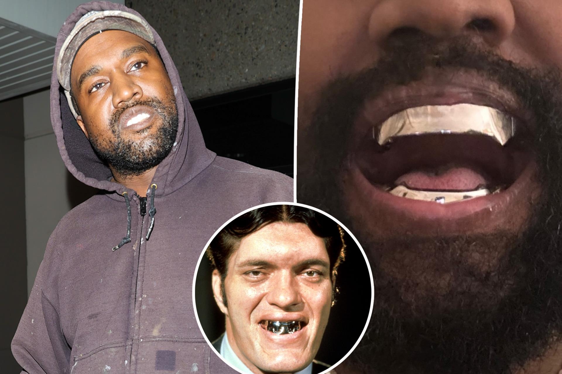 Kanye West gets $850K titanium teeth modeled after James Bond spy