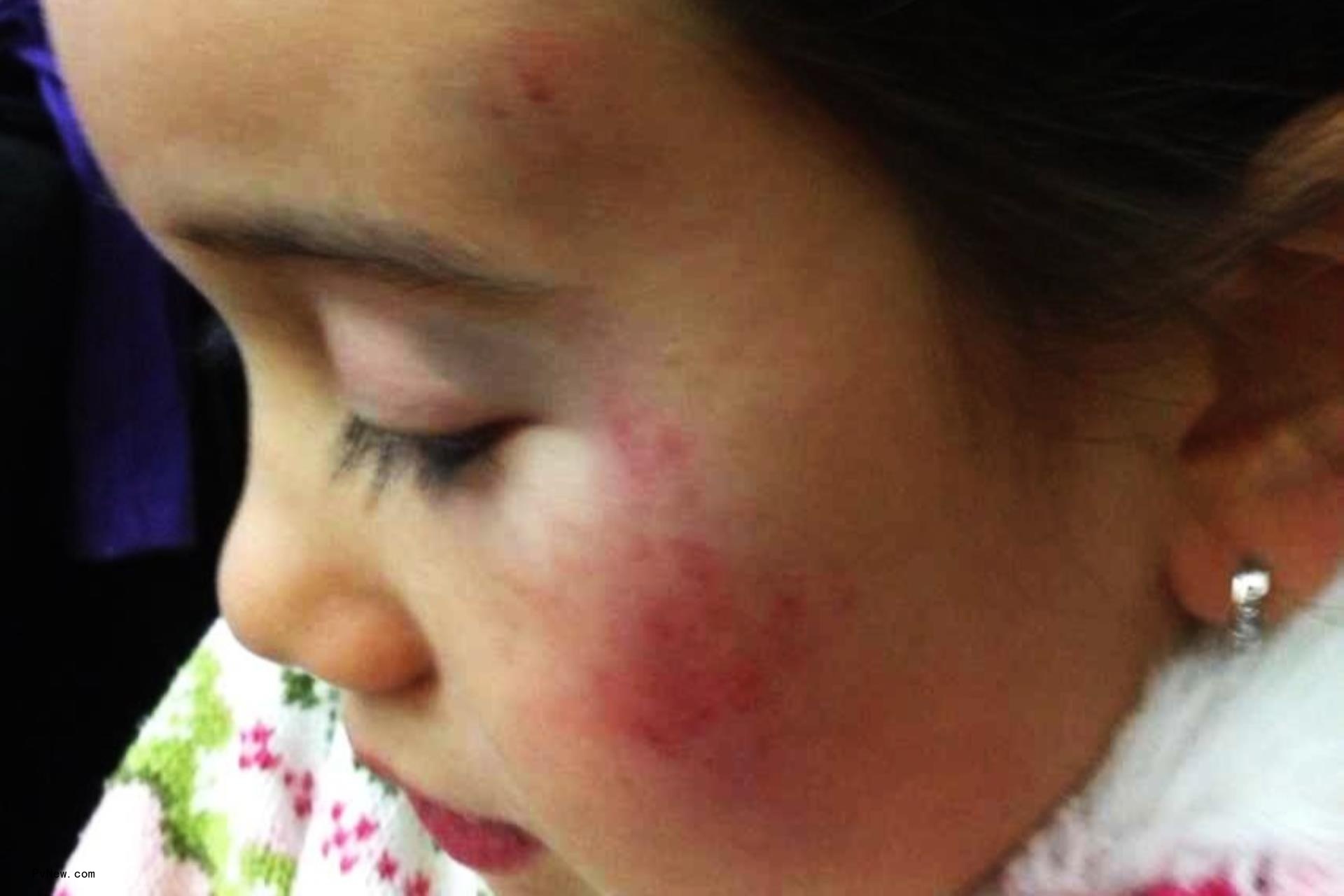 Lil Tay with red marks on her face.