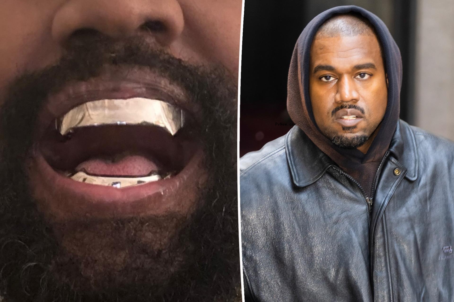Kanye West’s $850K titanium teeth are ‘fixed and permanent,’ unlike grills or veneers: It’s ‘experimental dentistry’