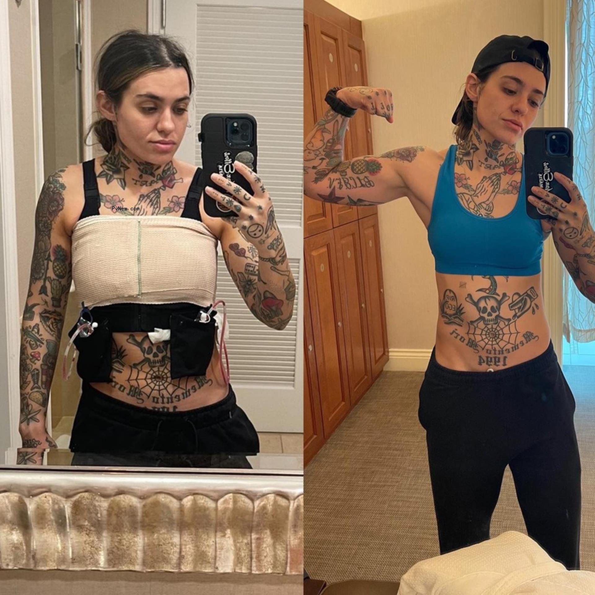 Morgan Wade after her surgery split with how she has healed.