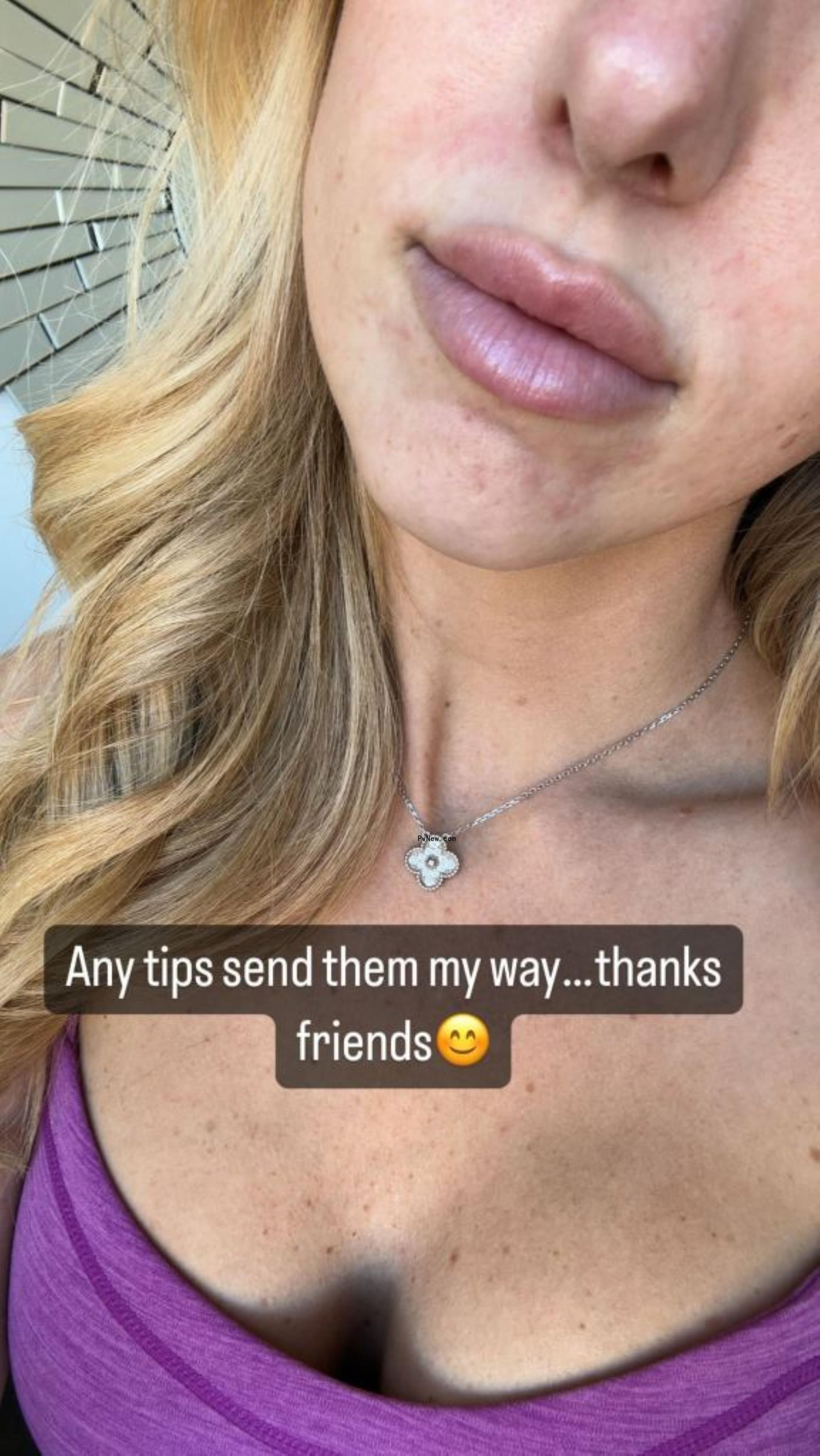 Brittany Mahomes close up of acne. 