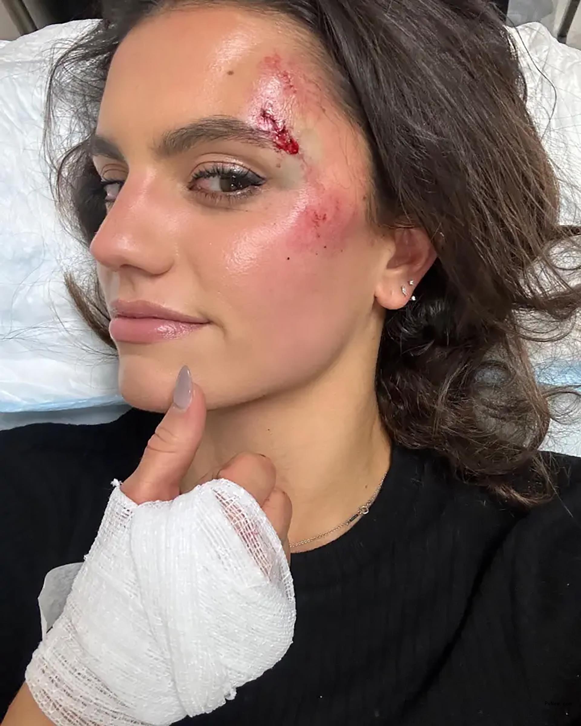 Hayley Erbert after her brain injury.