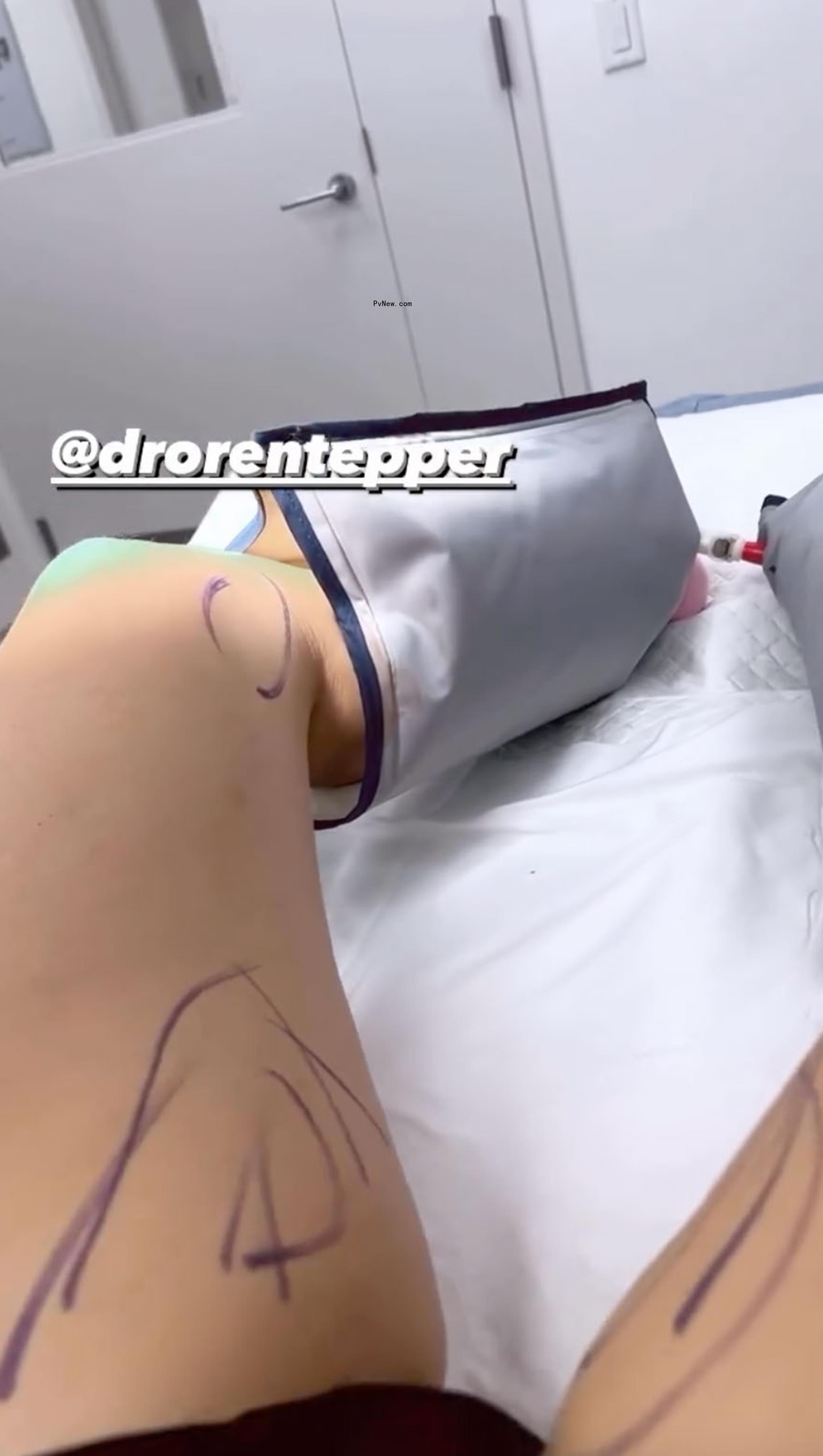picture of jenny mollen's leg marked up