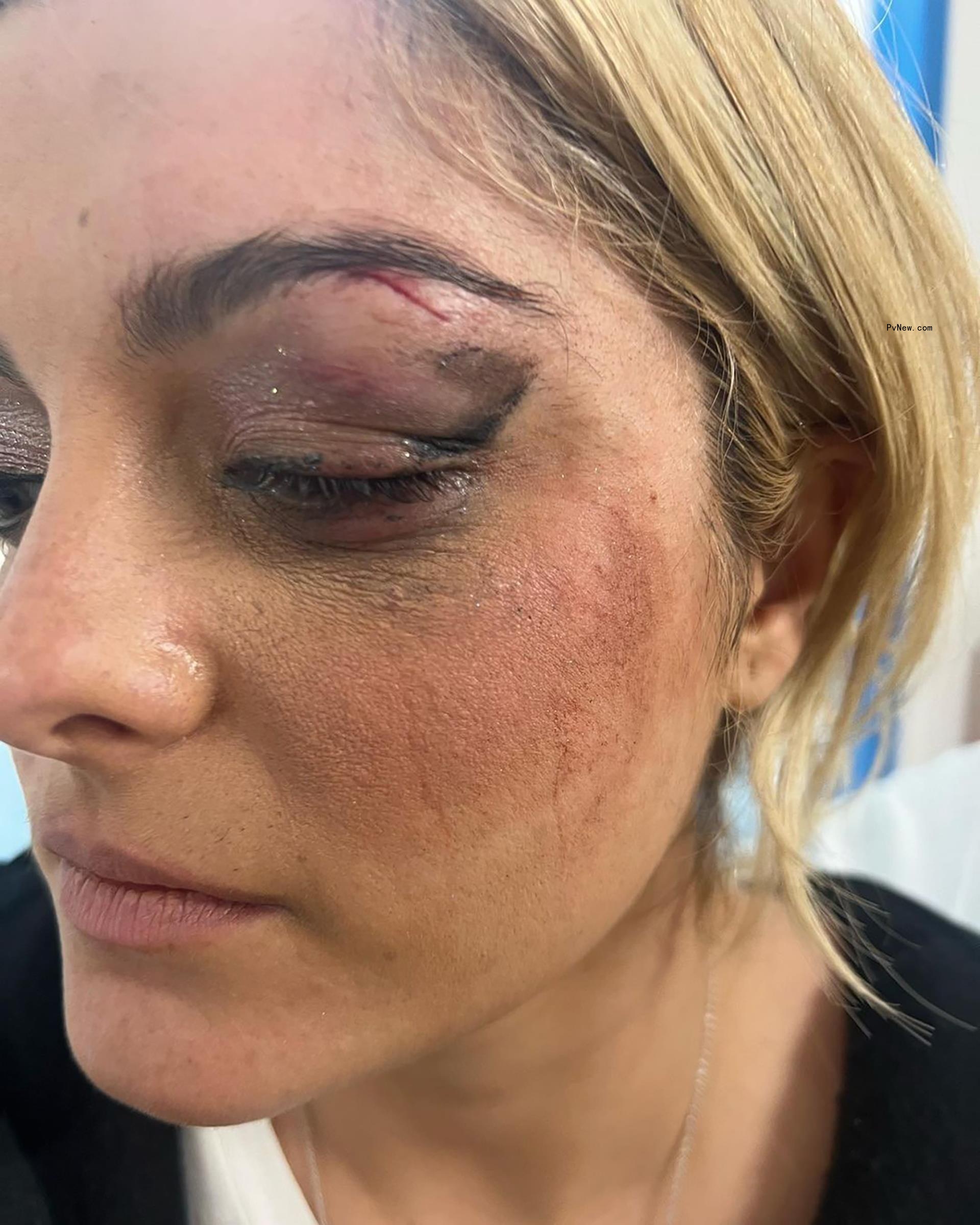 Bebe Rexha with a black eye. 
