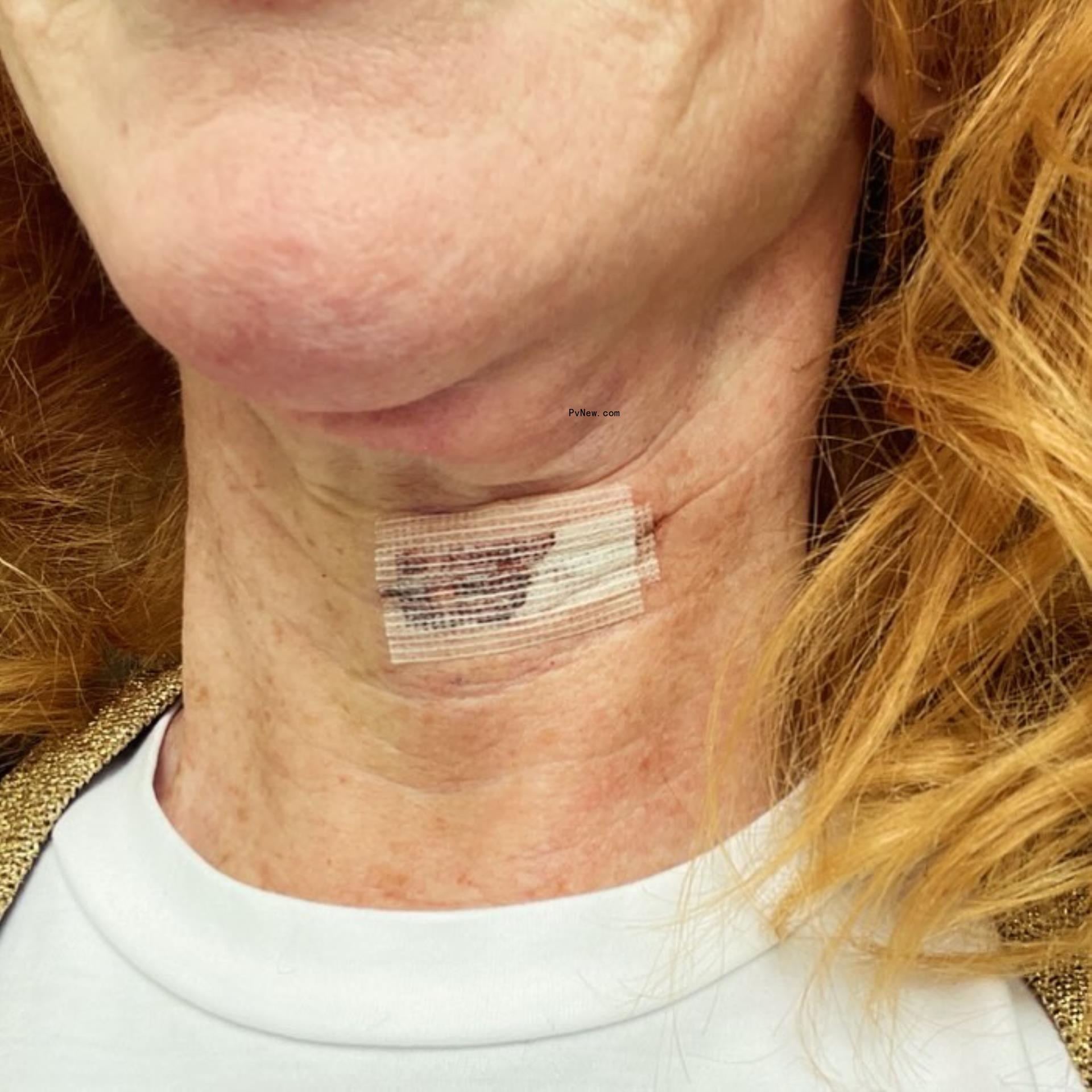 Kathy Griffin's neck wound after surgery