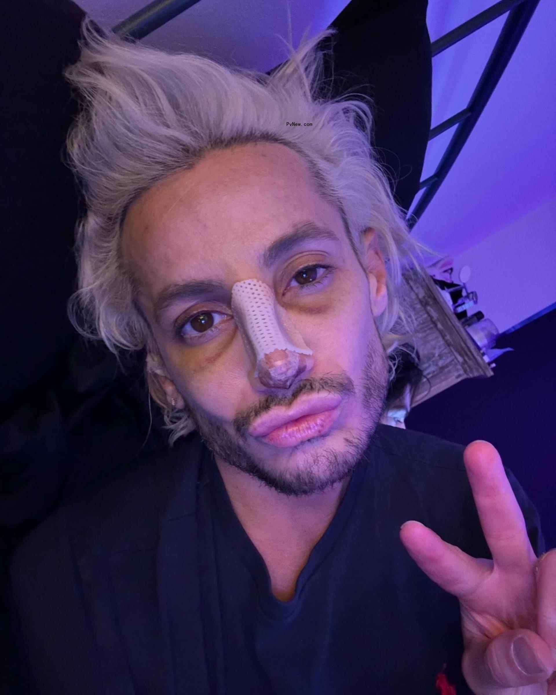 A screenshot of Frankie Grande's Instagram post of his bruised face.