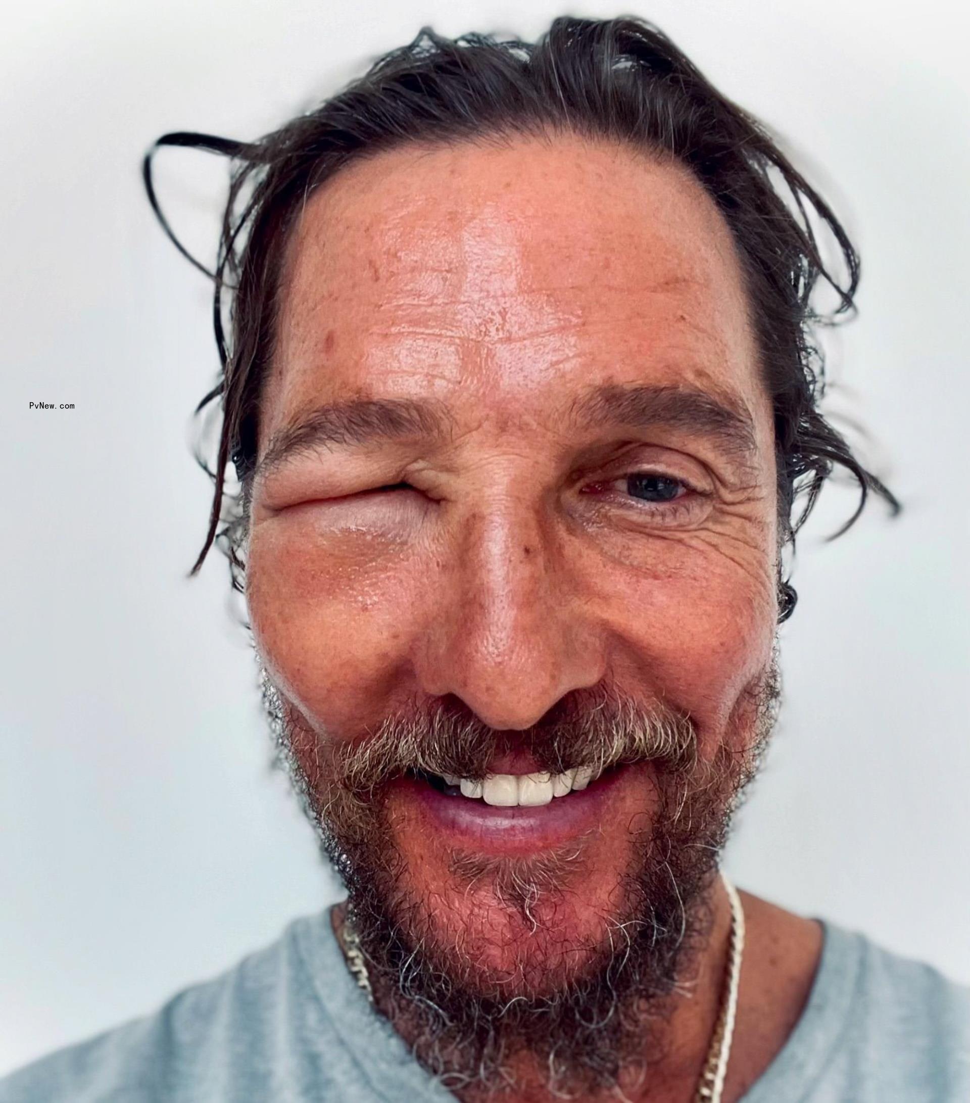 Matthew McCo<i></i>naughey smiling with a swollen eye due to a bee sting