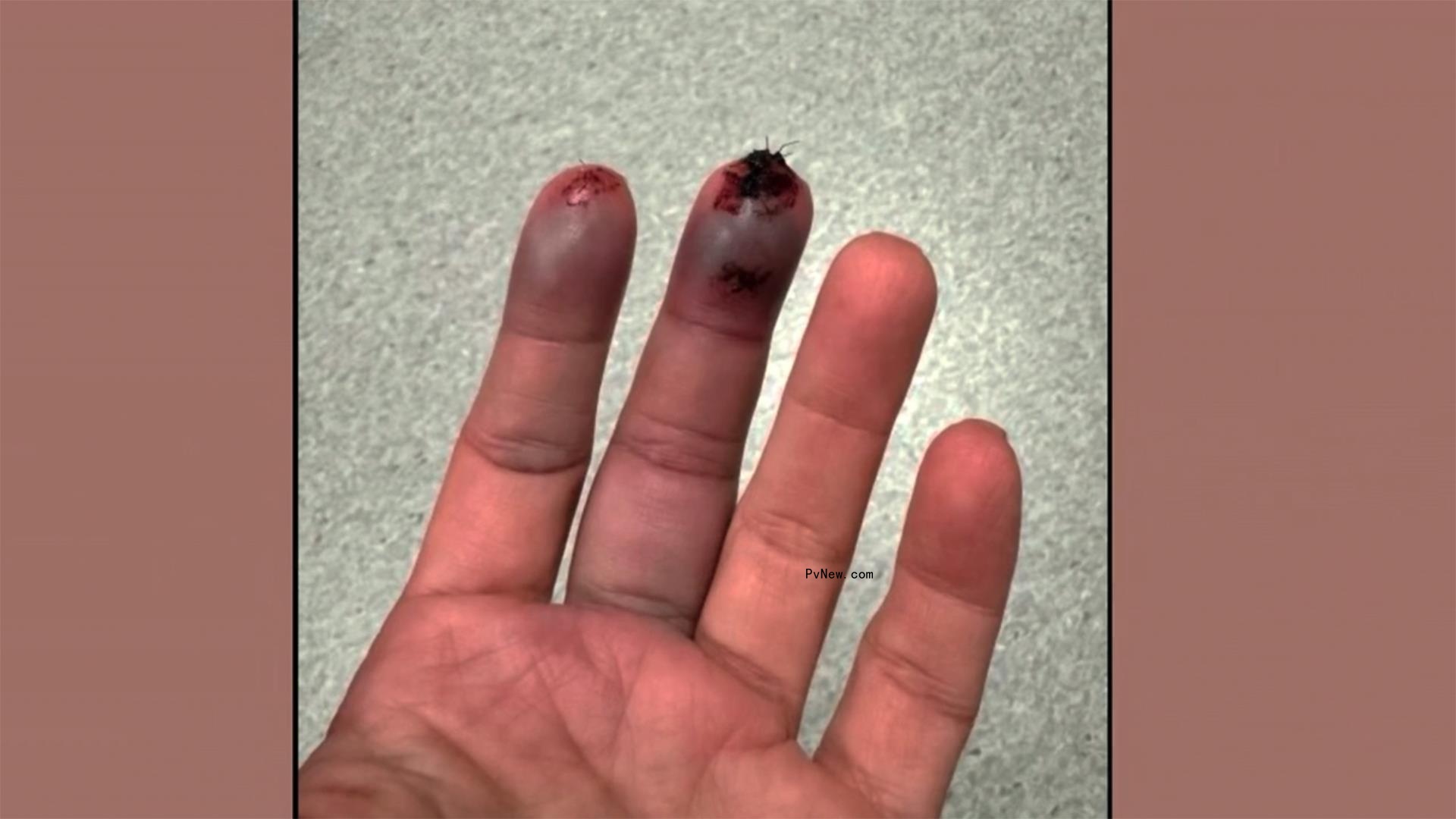 Kim Kardashian's injured fingers.