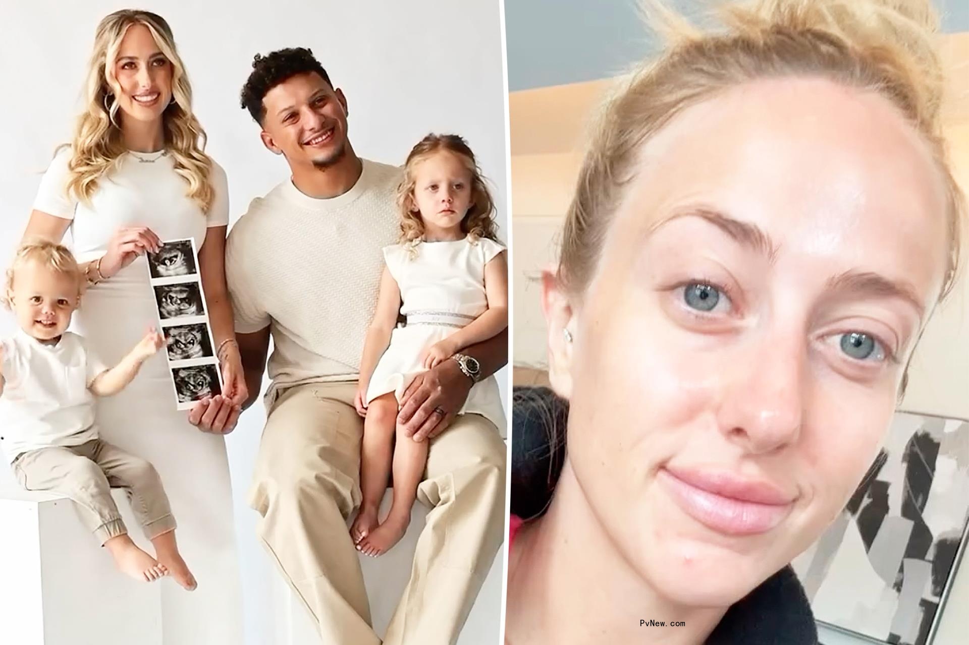 Brittany Mahomes gets real a<i></i>bout skin struggles during ‘hardest’ pregnancy yet