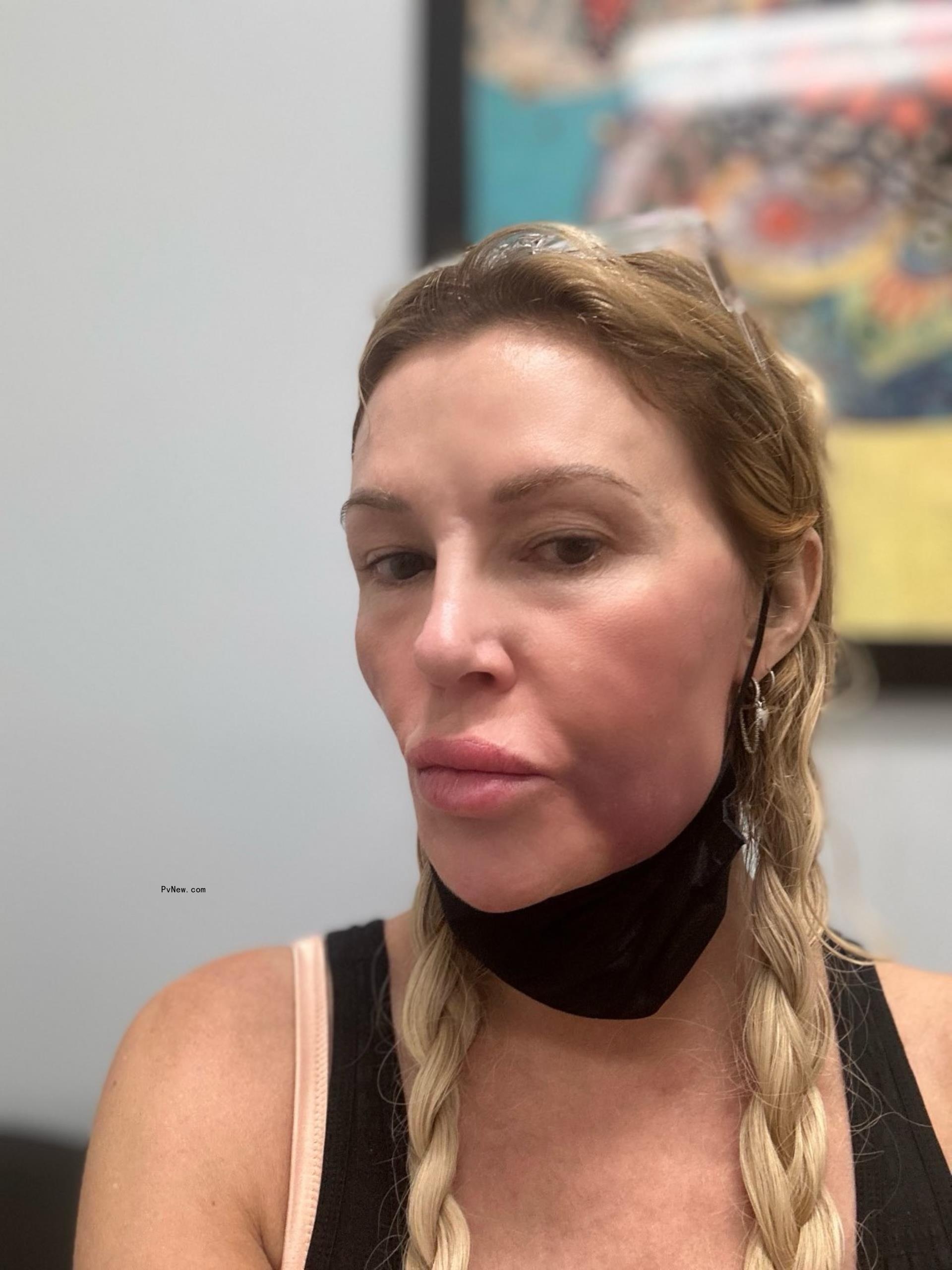 Brandi Glanville's swollen face.