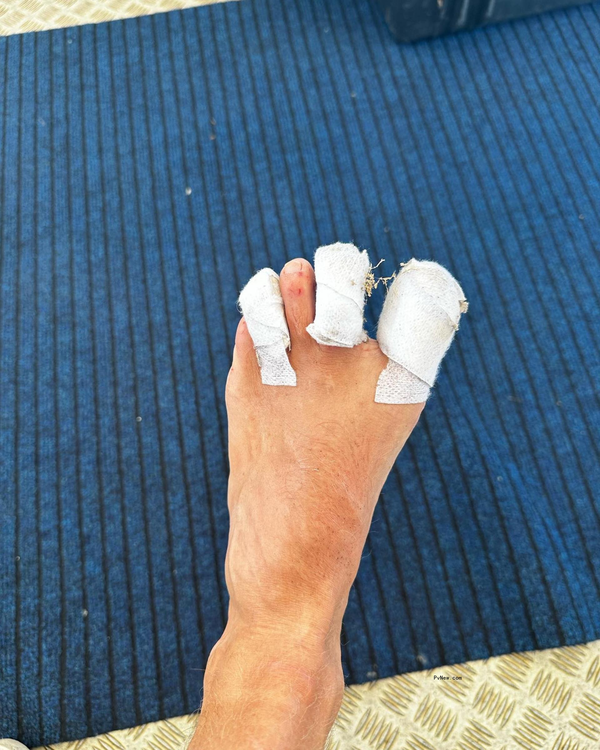 bandaged toes