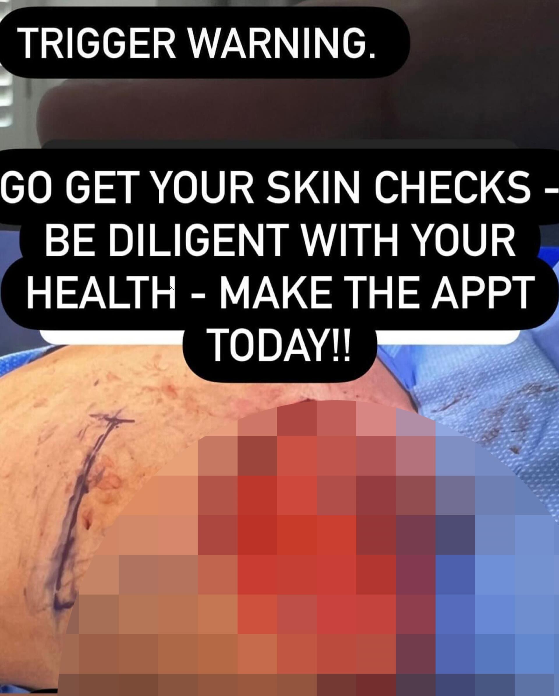 screenshot of teddi mellencamp lying on her stomach with a massive portion of skin removed from her back